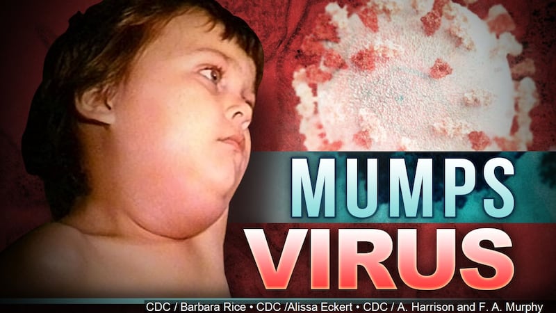 US mumps cases at highest level in 10 years